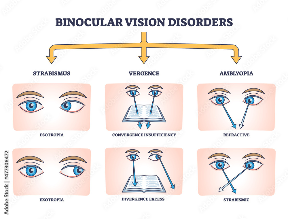 Vecteur Stock Binocular vision disorders with all eye defect examples