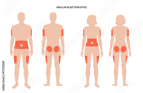 Insulin injection sites photo