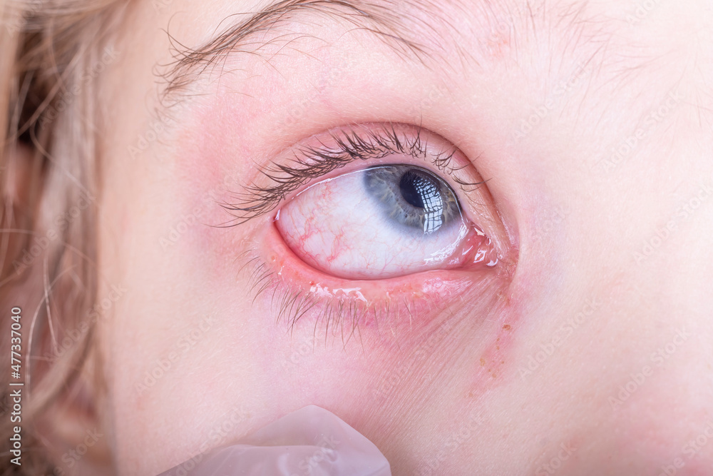 closeup. a girl with white hair. a tear flows from the eye, it is red