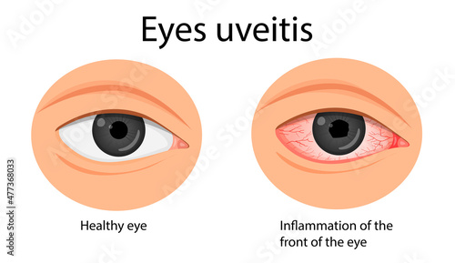 Eye irritation. konyuktevitis, keratitis, allergies, uveitis.