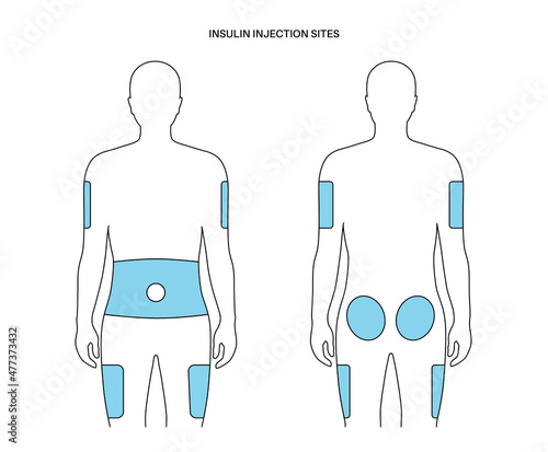 Insulin injection sites
