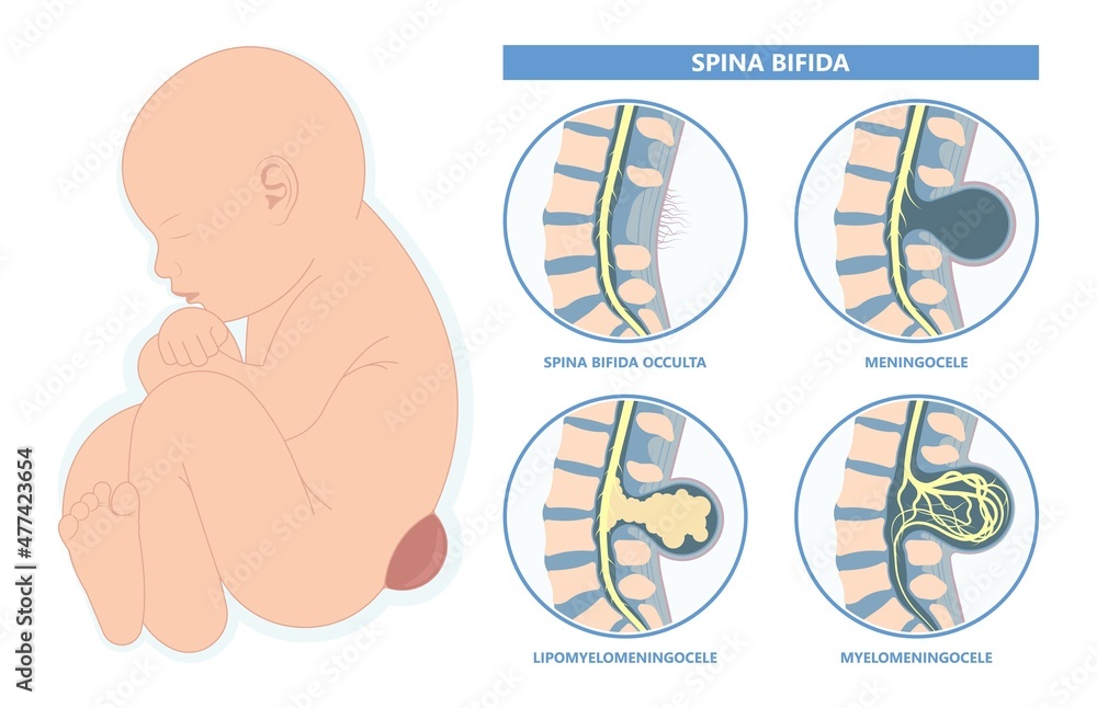 Vettoriale Stock Spina Bifida Pregnancy Non Invasive Neural Tube Gene