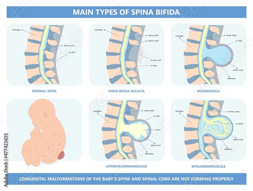 Spina bifida Pregnancy non invasive neural tube gene AFP NTD infant cord folate folic acid serum level sacral dimple child Lumbar birth NIPT test fetus born baby spine blood fluid villus alpha