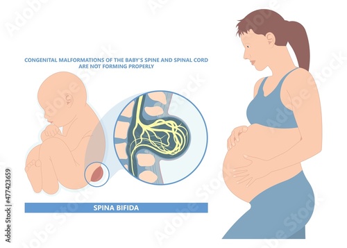 Spina bifida Pregnancy non invasive neural tube gene AFP NTD infant cord folate folic acid serum level sacral dimple child Lumbar birth NIPT test fetus born baby spine blood fluid villus alpha