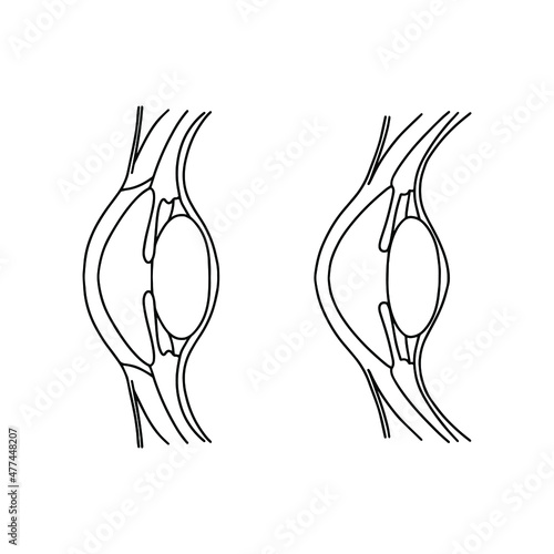 Eye accommodation scheme. Accelerated and non-accommodated eyes, linear medical drawing.
