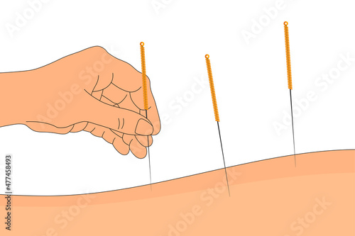 Acupuncture banner template. Human hand with chinese needles on back alternative medicine and treatment. Medical vector isolated eps illustration