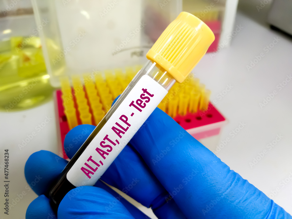 Blood sample for ALT (SGPT), AST (SGOT) and ALP test at medical