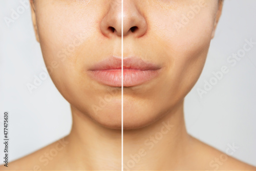 Cropped shot of young caucasian woman before and after plastic surgery buccal fat pad removal on a white background. A lower part of face with clear highlighted cheekbones. Result of cosmetic surgery