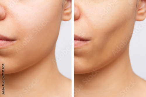 Cropped shot of young caucasian woman before and after plastic surgery buccal fat pad removal on a white background. Result of cosmetic surgery. Cosmetology concept photo