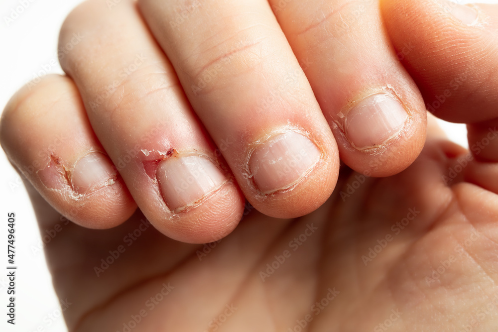 5 reasons to stop biting your nails  Vital Record
