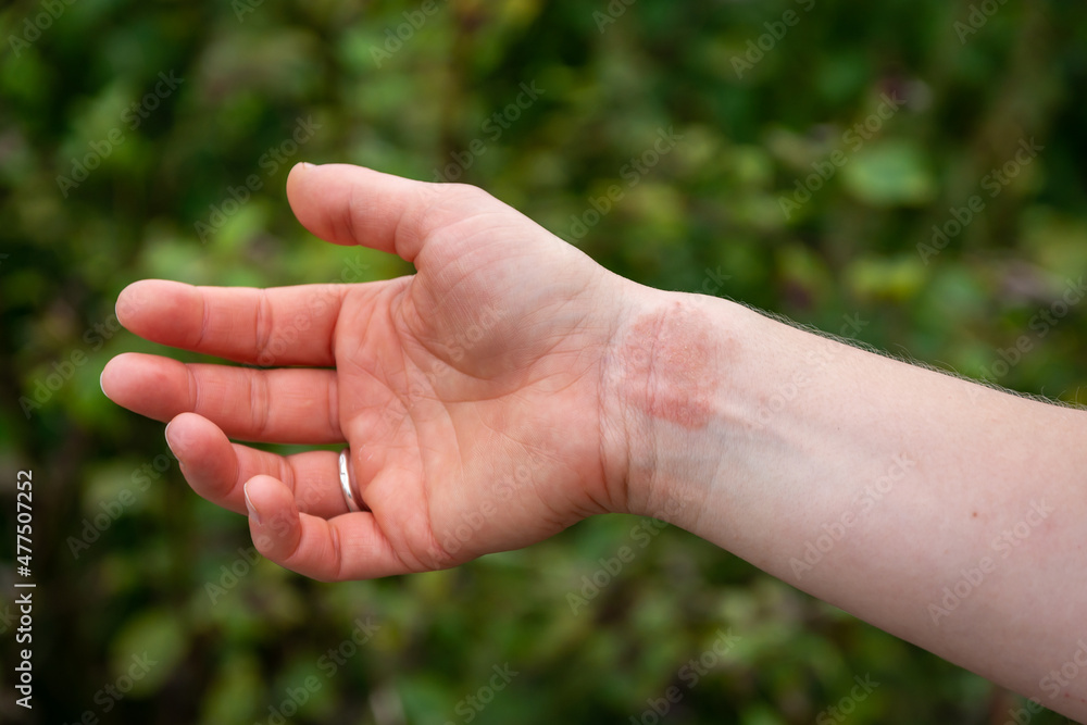 Dermatitis or eczema on human hand, close up of skin condition characterized by redness and a rash Dermatitis or eczema on human hand, close up of skin condition characterized by redness and a rash