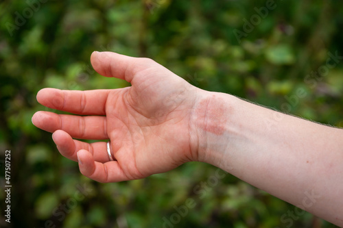 Dermatitis or eczema on human hand, close up of skin condition characterized by redness and a rash © Milos