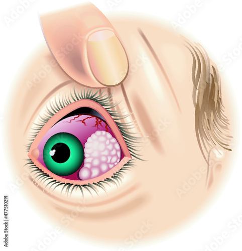 Medical illustration of an eye with tumor.