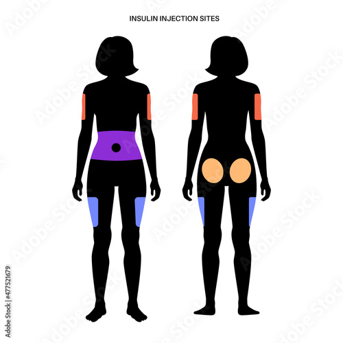 Insulin injection sites