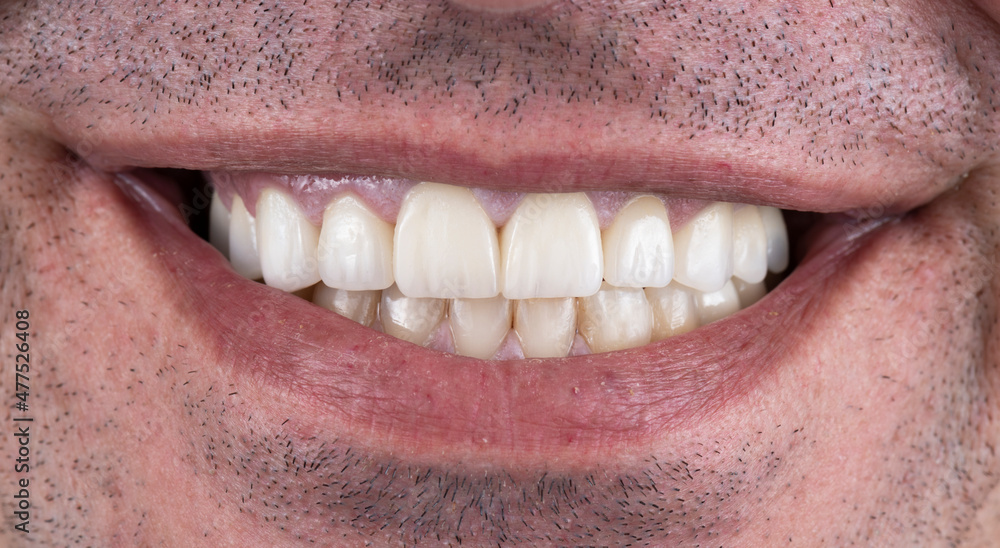 Obraz premium press ceramic crowns and veneers natural color