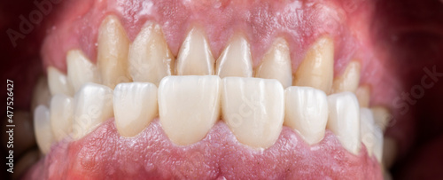 press ceramic crowns and veneers natural color