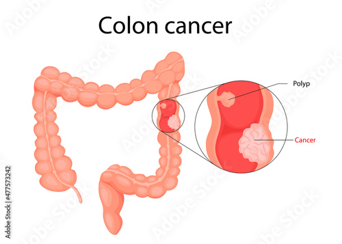 Human bladder cancer. malignant cells concept. Vector in cartoon style