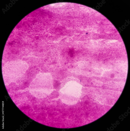 Microphotograph of breast lump, subareolar(FNA): Compatible with duct ectasia. smear show regular ductal epithelial cells on the background of proteinaceous material.