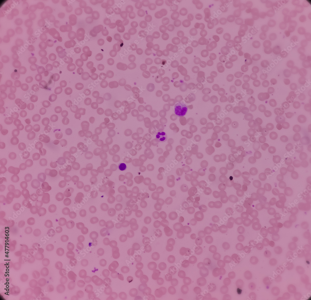 Microscopic image of macrocytic anaemia, folic acid deficiency, vitamin