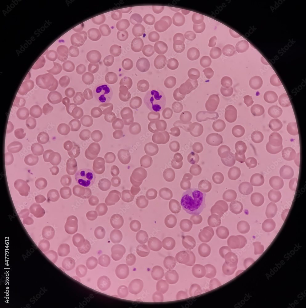 Microscopic image of macrocytic anaemia, folic acid deficiency, vitamin