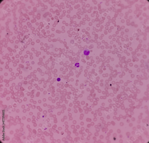 Microscopic image of macrocytic anaemia, folic acid deficiency, vitamin B12 deficiency. Macrocytic anemia is not a disease, photo