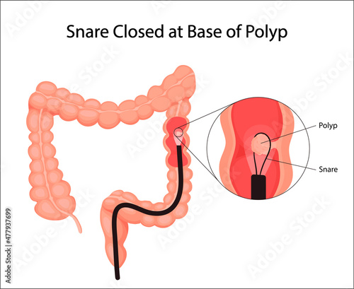 Human bladder cancer. malignant cells concept. Vector in cartoon style