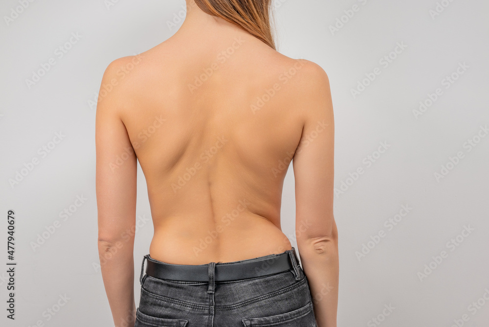 Woman with scoliosis of the spine. Curved woman's back. Stock