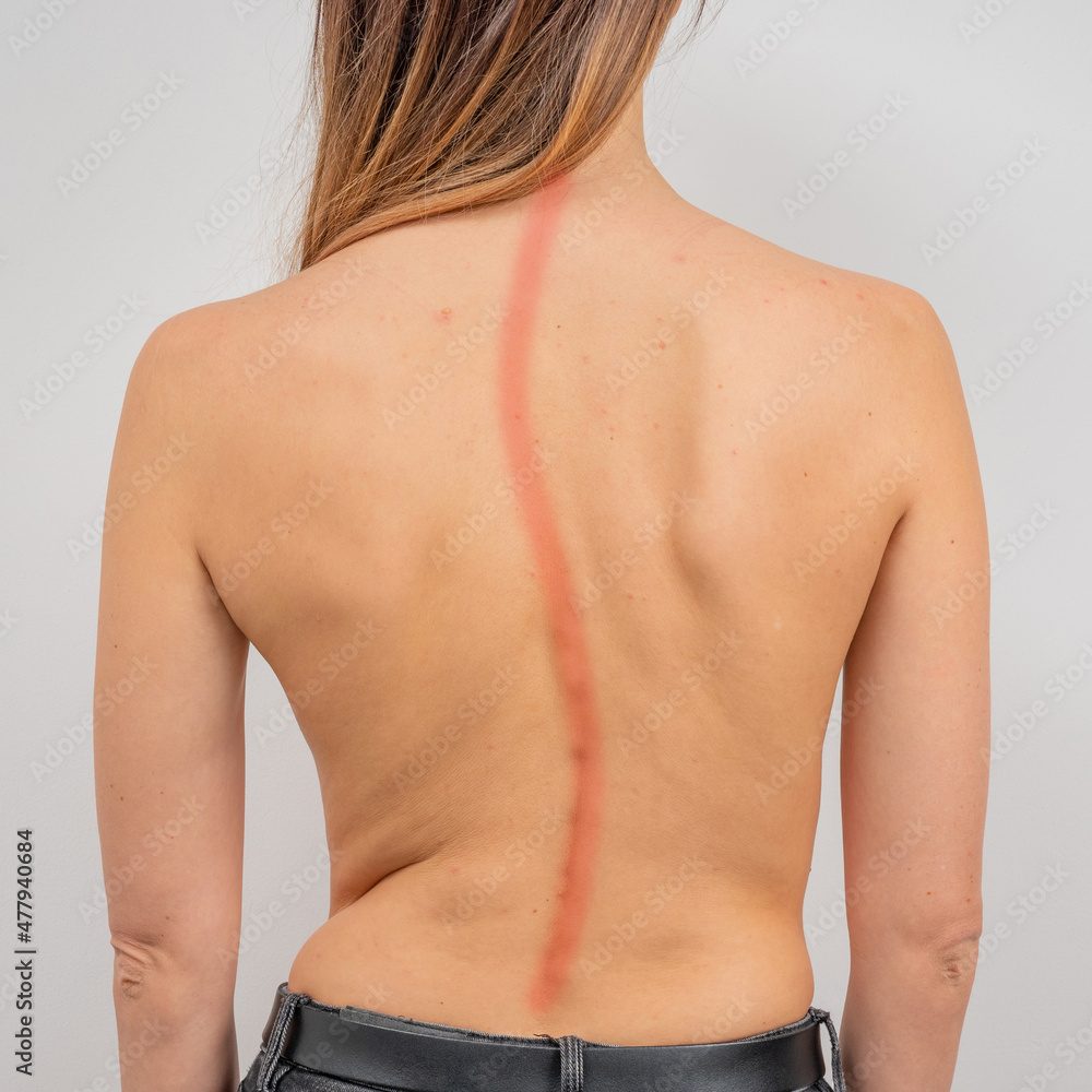 Woman with scoliosis of the spine. Curved woman's back with acne skin. - obrazy, fototapety, plakaty 