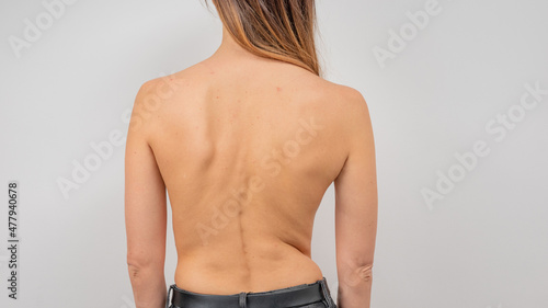 Woman with scoliosis of the spine. Curved woman's back with acne skin. photo
