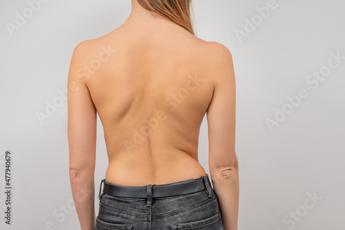 Woman with scoliosis of the spine. Curved woman's back.