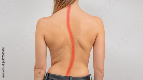 Woman with scoliosis of the spine. Curved woman's back. photo