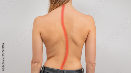 Fotografía Woman with scoliosis of the spine. Curved woman's back.