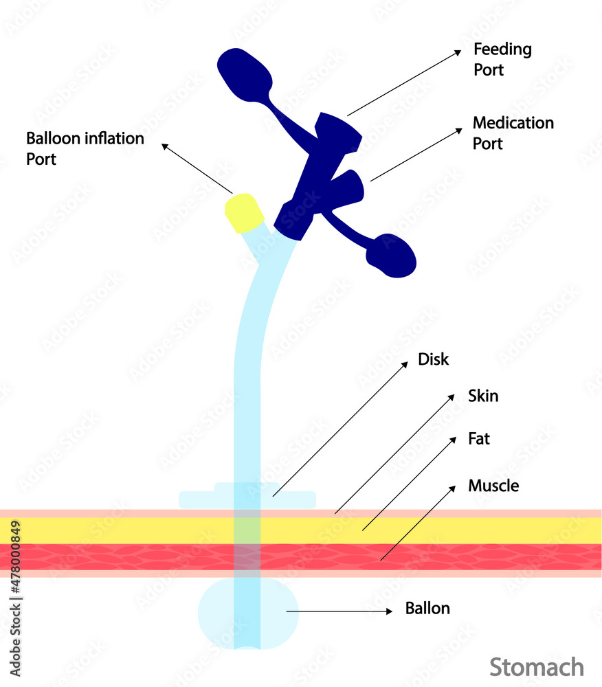 Gastrostomy enteral feed tube structures illustration. Parts of
