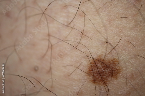 Obraz na plátně big brown skin mole on male caucasian skin