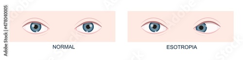 Esotropia. Horizontal strabismus before and after surgery. Eye misalignment, cross-eyed condition. Human eyes healthy and with inward gaze position. Double vision. Vector cartoon illustration photo