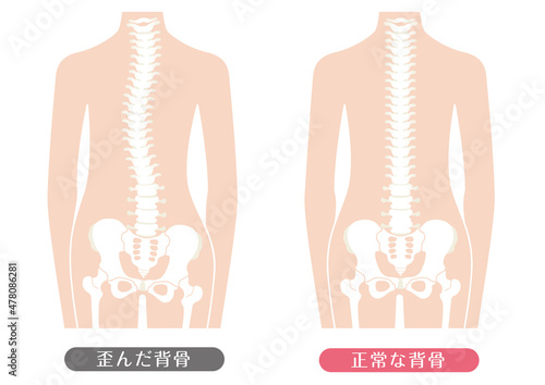 人間の体 正常な背骨と歪んだ背骨	
