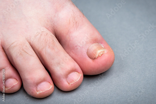 Onychomycosis fungal infection of toenail. Sick nail on the foot after damaging with tight shoes. photo
