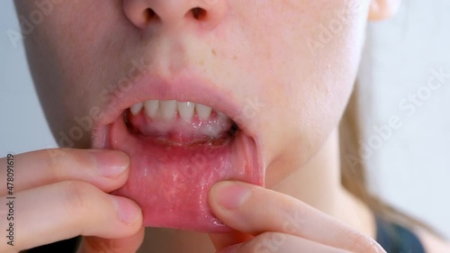 Stomatitis in woman's mouth after dental treatment, disease in the mouth. Stomatitis on the lower lip. Large ulcers in the mouth under the lower teeth. Treatment and diseases of the oral cavity. photo