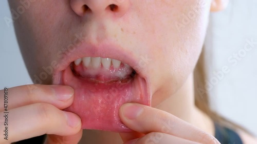 Stomatitis in woman's mouth after dental treatment, disease in the mouth. Stomatitis on the lower lip. Large ulcers in the mouth under the lower teeth. Treatment and diseases of the oral cavity.