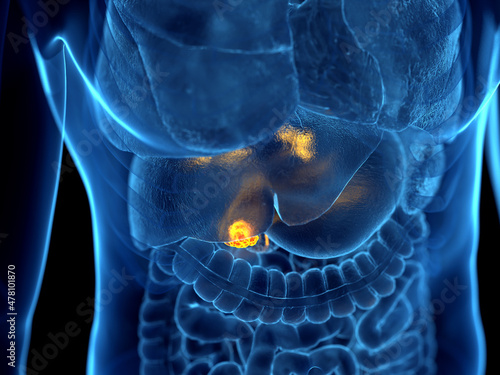 3d rendered illustration of gallbladder cancer