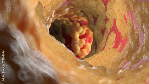 Canvas Print 3d rendered illustration of a fatty human artery