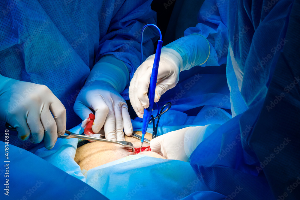 Φωτογραφία Close-up of the hands of surgeons in sterile gloves operate with an electric coagulator during a surgical operation