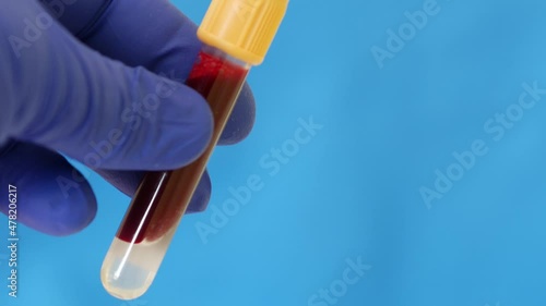 Container of human blood. Hand in blue nitrile glove holds test tube containing sample of human venous blood. Lab technician is holding test tube. Health care worker receives blood for analysis photo