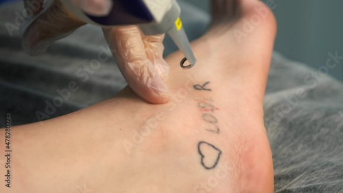 Laser removing of tattoo with words loser, lover and heart on woman's foot in red and black colours, closeup hands of doctor in gloves. Romantic tattoo symbol of youth love and disappointment in life.