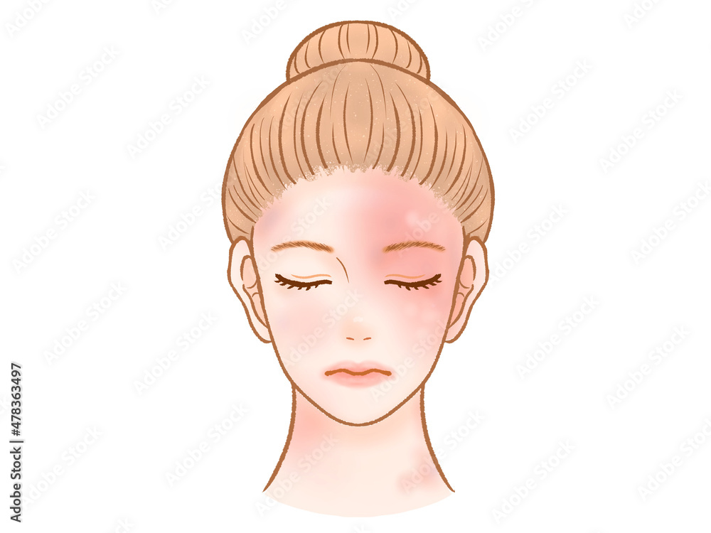 顔にあざのある大人の女性のイラスト素材 顔にあざのある大人の女性のイラスト素材