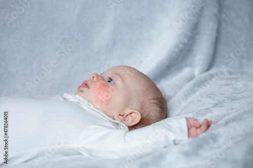 Newborn baby with dermatitis allergy.