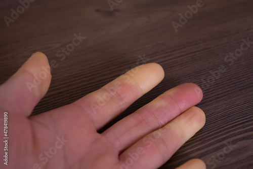 レイノー症状でまだらに変色している指