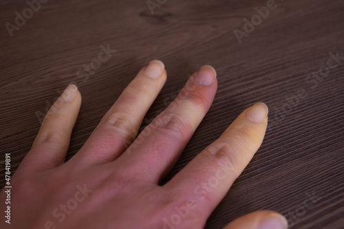 レイノー症状でまだらに変色している指