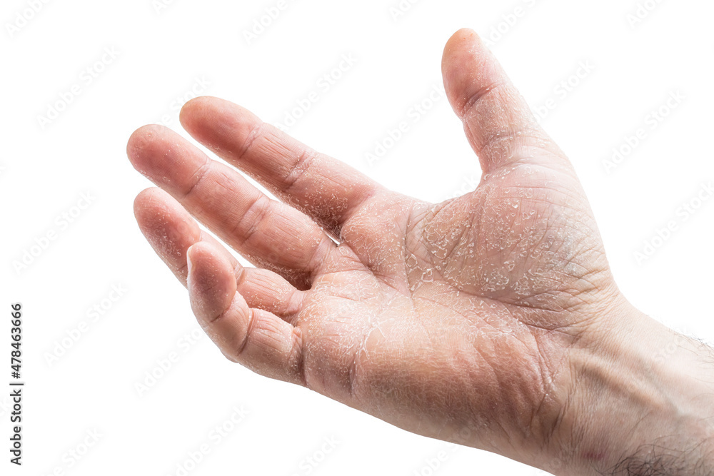 image of the mens hand showing skin disease isolated on white background image of the mens hand showing skin disease isolated on white background