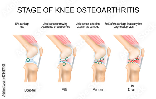 knee Osteoarthritis Stages photo